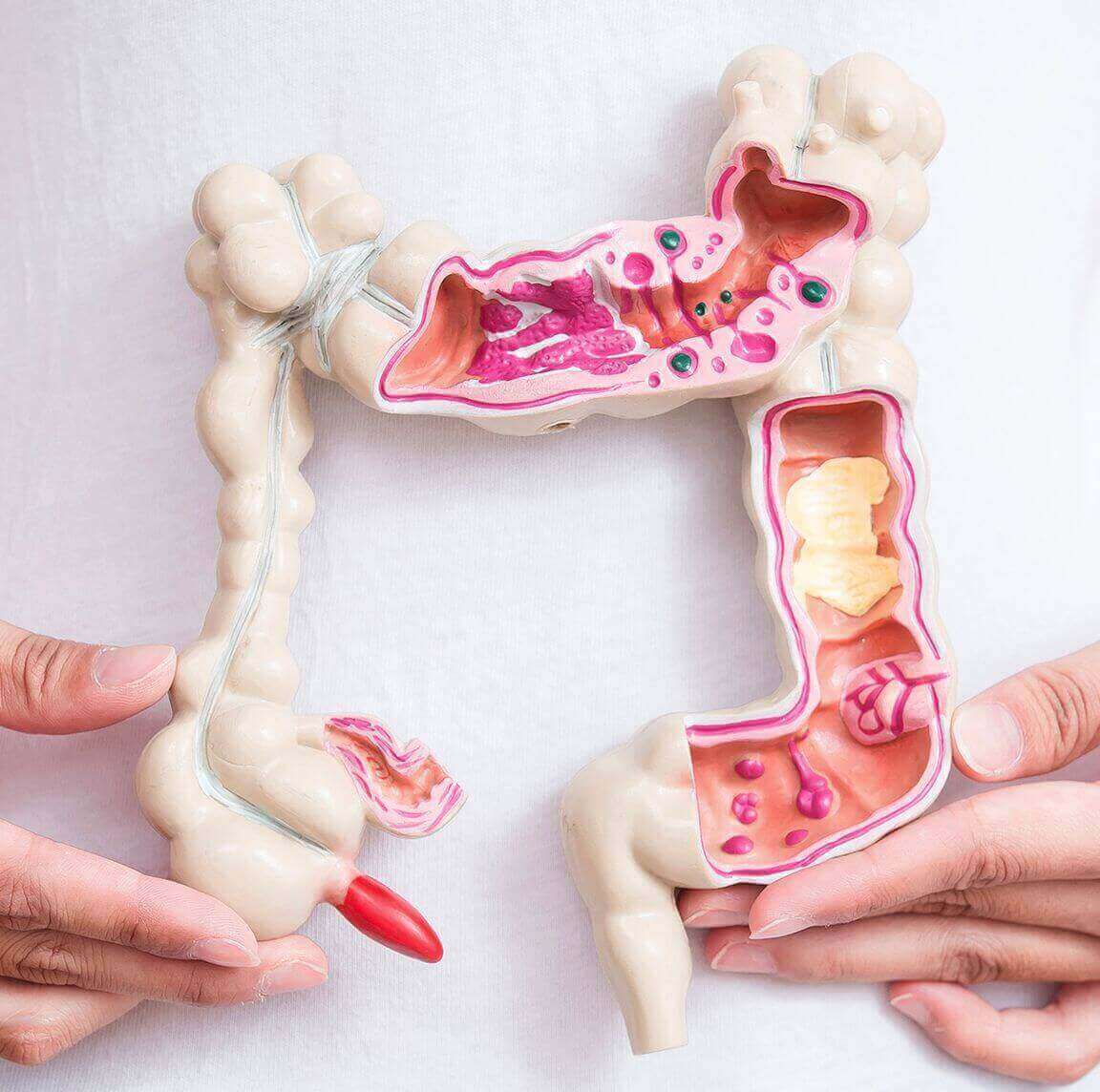 Minimally invasive colorectal surgery using laparoscopic technique in Dubai