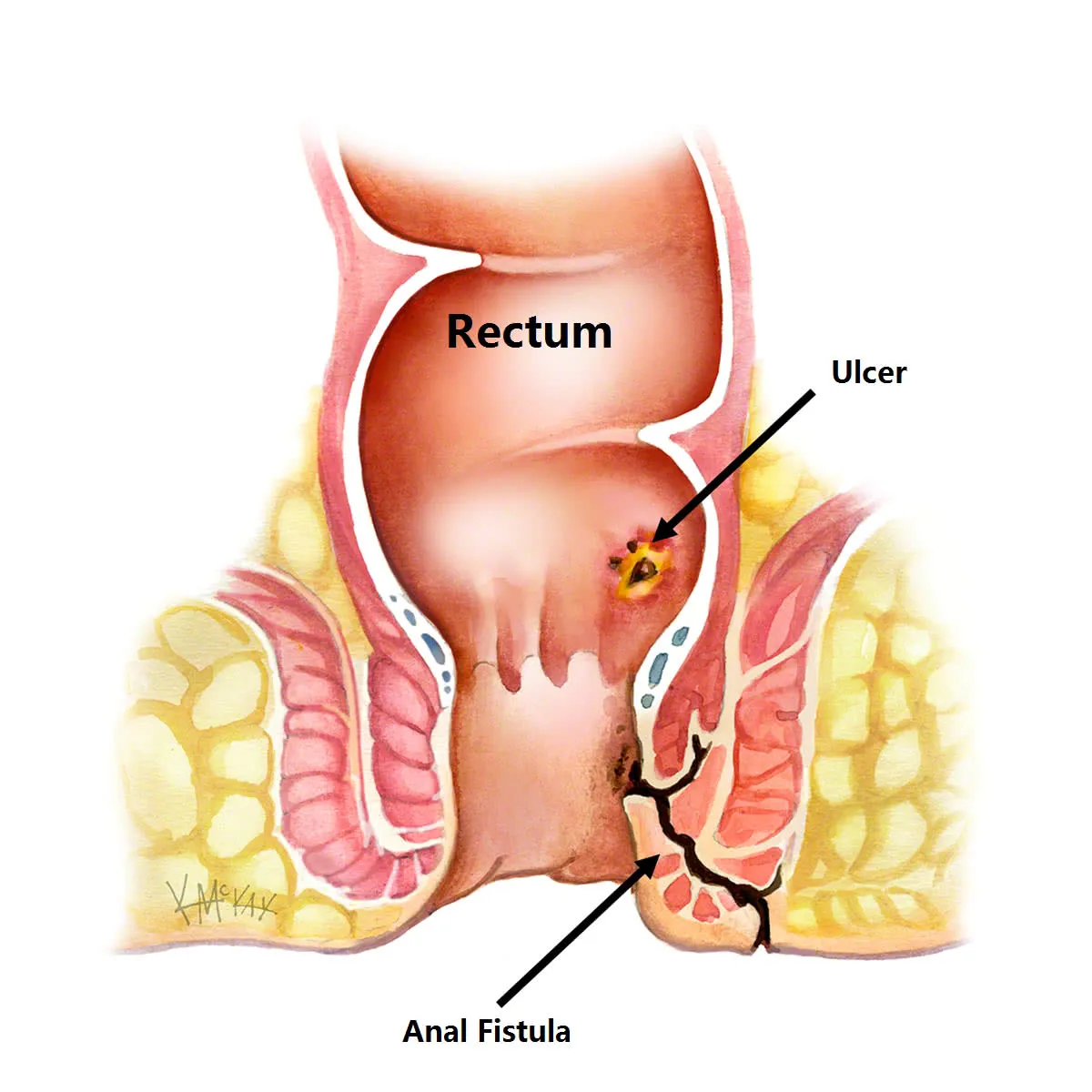 Best Treatment for Fistula